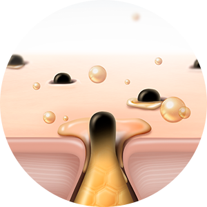 모공 및 각질 흡입