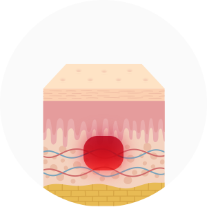 기존 피부 속만 재생하는 레이저